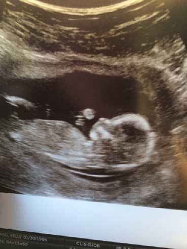 weeks 13 6 days sono